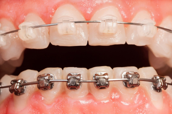 Dental Implant In Mumbai