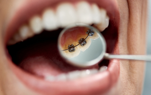 Lingual Braces in Mumbai