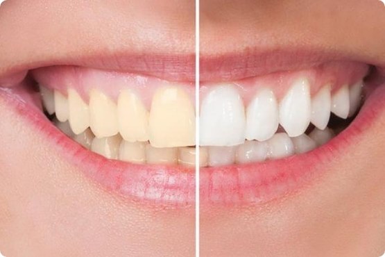 Teeth whitening treatment cost in mumbai AK Dental Clinic