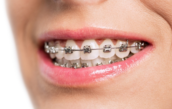 Traditional Metal Braces