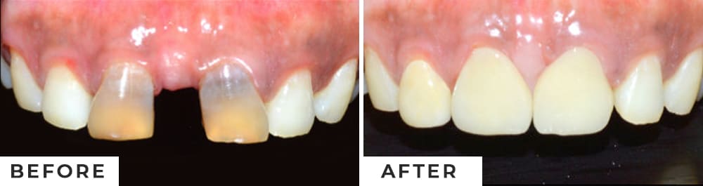 Masking Discoloured Teeth With Ceramic Crowns