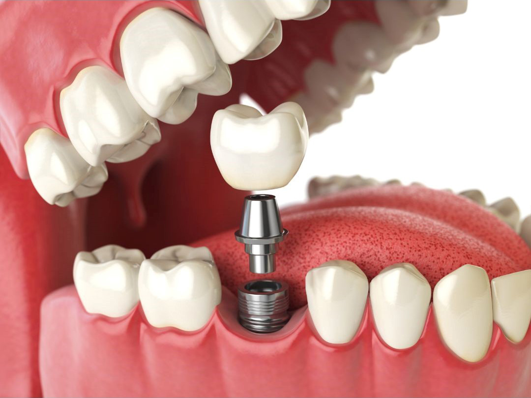 What Is A Dental Implant?