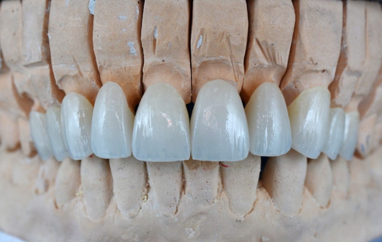 What Is A Dental Implant?