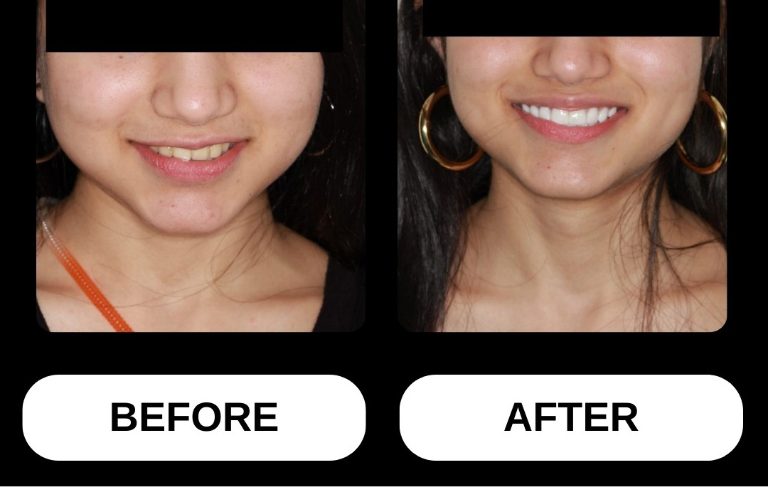 What Is A Dental Implant?