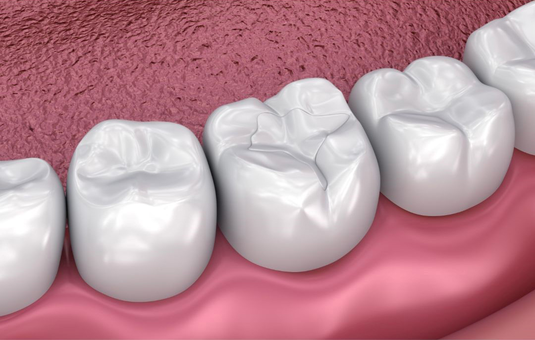 Dental Implant In Mumbai