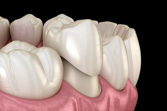 Dental Implant In Mumbai