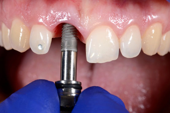 Dental Implant In Mumbai