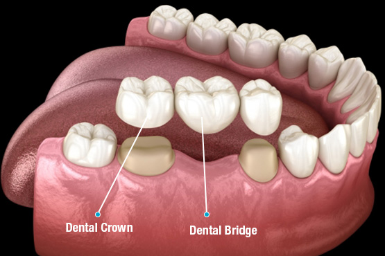 What Is A Dental Implant?