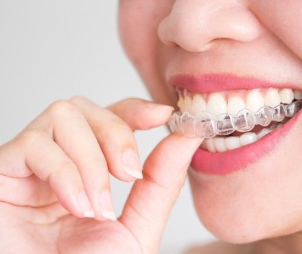 Invisalign- Invisible braces