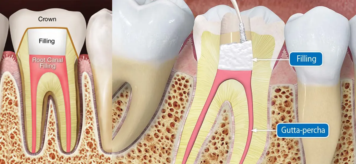 Root Canal & Fillings