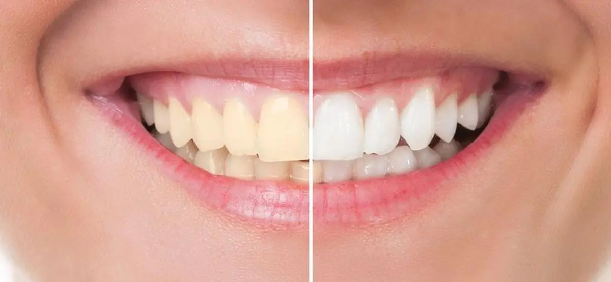 Instant Teeth Whitening