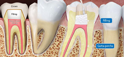 Root Canal & Fillings